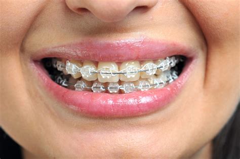 Does Age Matter When Getting Witching Smile Teeth Braces?